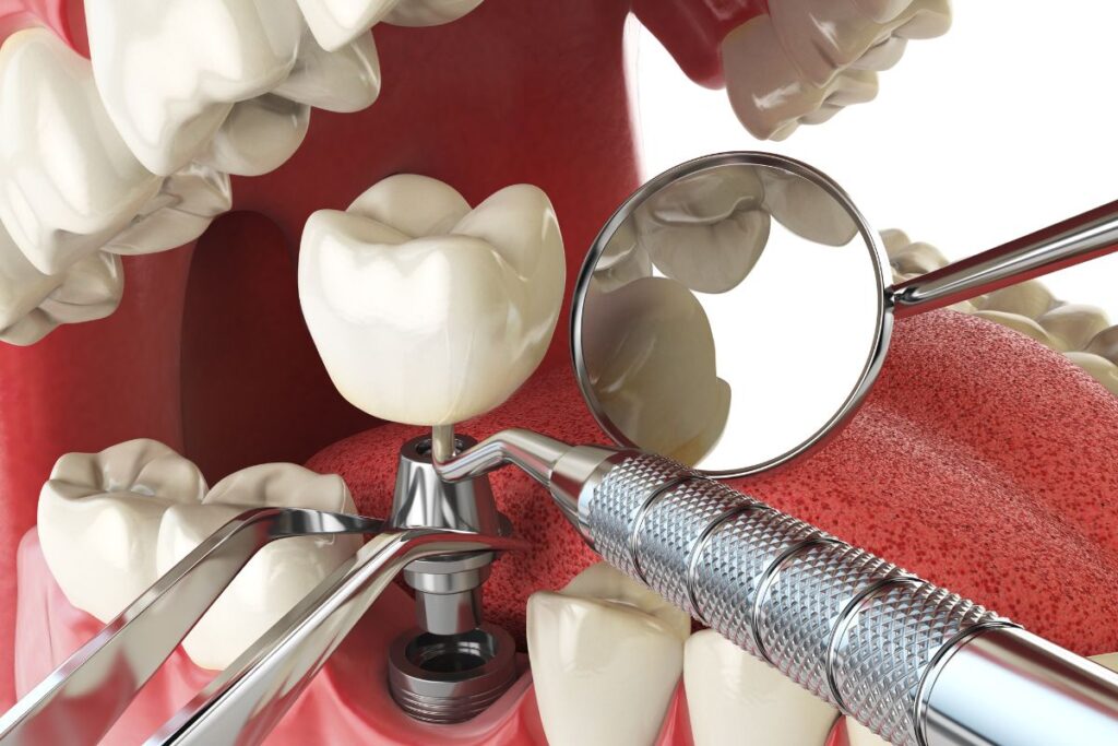 co zamiast implantu